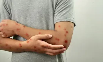 تسجيل اول حالة لجذري القردة بالمغرب