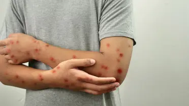 تسجيل اول حالة لجذري القردة بالمغرب