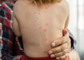 تطور الوضعية الوبائية في المغرب.. بوحمرون ينتشر بين جميع الفئات