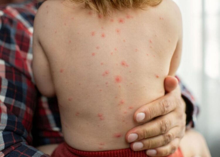 تطور الوضعية الوبائية في المغرب.. بوحمرون ينتشر بين جميع الفئات