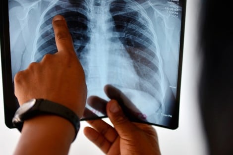 وزارة الصحة تعزز جهود الكشف والتكفل بجميع أشكال السل بمناسبة اليوم العالمي لمكافحة السل 2026